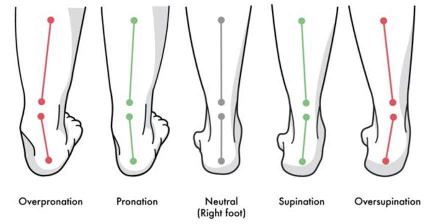 Rear view of five right heels, from overpronation through pronation, neutral and supination to oversupination. Lines along the lower leg and the heel show the angle between them, which is straight in the neutral heel and tilted inward or outward in the others.